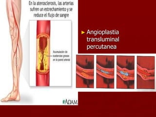 ► Angioplastia
  transluminal
  percutanea
 