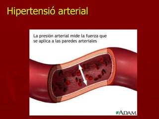 Hipertensió arterial
 