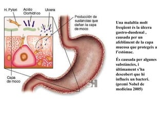 Una malaltia molt freqüent és la úlcera gastro-duodenal , causada per un afebliment de la capa mucosa que protegeix a l’estómac. És causada per algunes substàncies, i últimament s’ha descobert que hi influeix un bacteri. (premi Nobel de medicina 2005) 