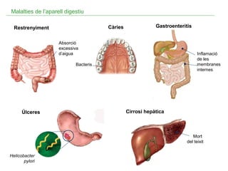 Malalties de l’aparell digestiu
Càries

Restrenyiment

Gastroenteritis

Absorció
excessiva
d’aigua

Inflamació
de les
membranes
internes

Bacteris

Úlceres

Cirrosi hepàtica

Mort
del teixit
Helicobacter
pylori

 