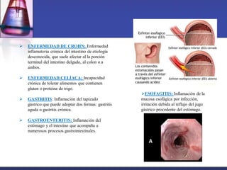  ENFERMEDAD DE CROHN; Enfermedad
inflamatoria crónica del intestino de etiología
desconocida, que suele afectar al la porción
terminal del intestino delgado, al colon o a
ambos.
 ENFERMEDAD CELÍACA: Incapacidad
crónica de tolerar alimentos que contienen
gluten o proteína de trigo.
 GASTRITIS: Inflamación del tapizado
gástrico que puede adoptar dos formas: gastritis
aguda o gastritis crónica.
 GASTROENTERITIS: Inflamación del
estómago y el intestino que acompaña a
numerosos procesos gastrointestinales.
ESOFAGITIS: Inflamación de la
mucosa esofágica por infección,
irritación debida al reflujo del jugo
gástrico procedente del estómago.
 