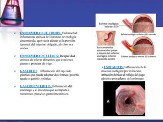  ENFERMEDAD DE CROHN; Enfermedad
inflamatoria crónica del intestino de etiología
desconocida, que suele afectar al la porción
terminal del intestino delgado, al colon o a
ambos.
 ENFERMEDAD CELÍACA: Incapacidad
crónica de tolerar alimentos que contienen
gluten o proteína de trigo.
 GASTRITIS: Inflamación del tapizado
gástrico que puede adoptar dos formas: gastritis
aguda o gastritis crónica.
 GASTROENTERITIS: Inflamación del
estómago y el intestino que acompaña a
numerosos procesos gastrointestinales.
ESOFAGITIS: Inflamación de la
mucosa esofágica por infección,
irritación debida al reflujo del jugo
gástrico procedente del estómago.
 