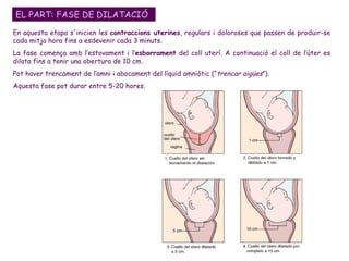 En aquesta etapa s'inicien les  contraccions uterines , regulars i doloroses que passen de produir-se cada mitja hora fins a esdevenir cada 3 minuts.  La fase comença amb l’estovament i l’ esborrament  del coll uterí. A continuació el coll de l’úter es dilata fins a tenir una obertura de 10 cm.  Pot haver trencament de l’amni i abocament del líquid amniòtic (“ trencar aigües ”). Aquesta fase pot durar entre 5-20 hores.  EL PART: FASE DE DILATACIÓ 