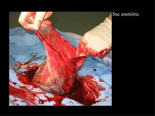 Sac amniòtic 