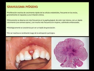 GRANULOMA PIÓGENO
•Proliferación reactiva de crecimiento rápido de las células endoteliales, frecuente en las encías,
generalmente en repuesta a una irritación crónica.

•Clínicamente se observa con más frecuencia en la papila gingival, de color rojo intenso, con un rápido
crecimiento (una semana aprox.), con mucha más frecuencia en mujeres, sobretodo embarazadas.

•Histológicamente se caracteriza por ser un tejido de granulación.

•Por ser reactiva es recidivante luego de la extirpación quirúrgica.
 