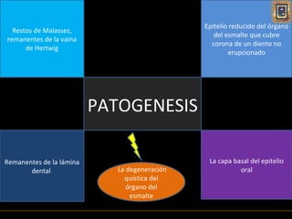 Epitelio reducido del órgano
  Restos de Malassez,
                                                  del esmalte que cubre
remanentes de la vaina
                                                 corona de un diente no
      de Hertwig
                                                        erupcionado




                          PATOGENESIS

Remanentes de la lámina                         La capa basal del epitelio
       dental                La degeneración              oral
                               quística del
                                órgano del
                                 esmalte
 