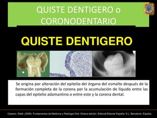 QUISTE DENTIGERO o
                           CORONODENTARIO




       Se origina por alteración del epitelio del órgano del esmalte después de la
       formación completa de la corona por la acumulación de líquido entre las
       capas del epitelio adamantino o entre este y la corona dental.



                                                                                                                                 .
Cawson, Odell. (2009). Fundamentos de Medicina y Patologia Oral. Octava edición. Editorial Elsevier España. S.L. Barcelona. España
 