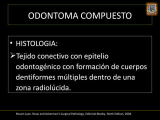 ODONTOMA COMPUESTO

• HISTOLOGIA:
Tejido conectivo con epitelio
 odontogénico con formación de cuerpos
 dentiformes múltiples dentro de una
 zona radiolúcida.


 Rosain Juan. Rosai and Ackerman’s Surgical Pathology. Editorial Mosby. Ninth Edition, 2004.
 