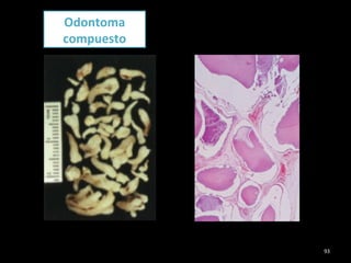 Odontoma
compuesto




            93
 