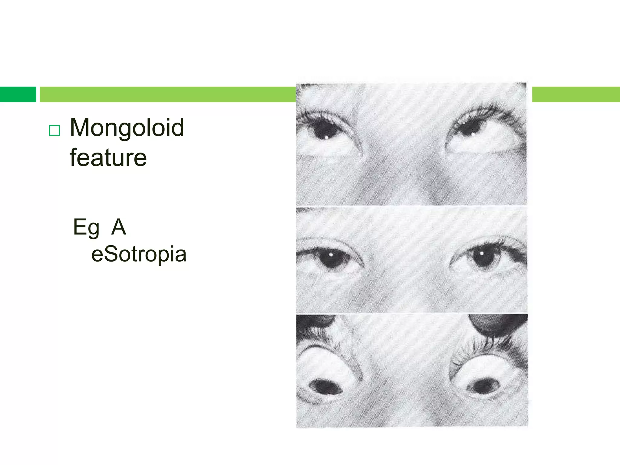    Mongoloid
    feature

    Eg A
     eSotropia
 