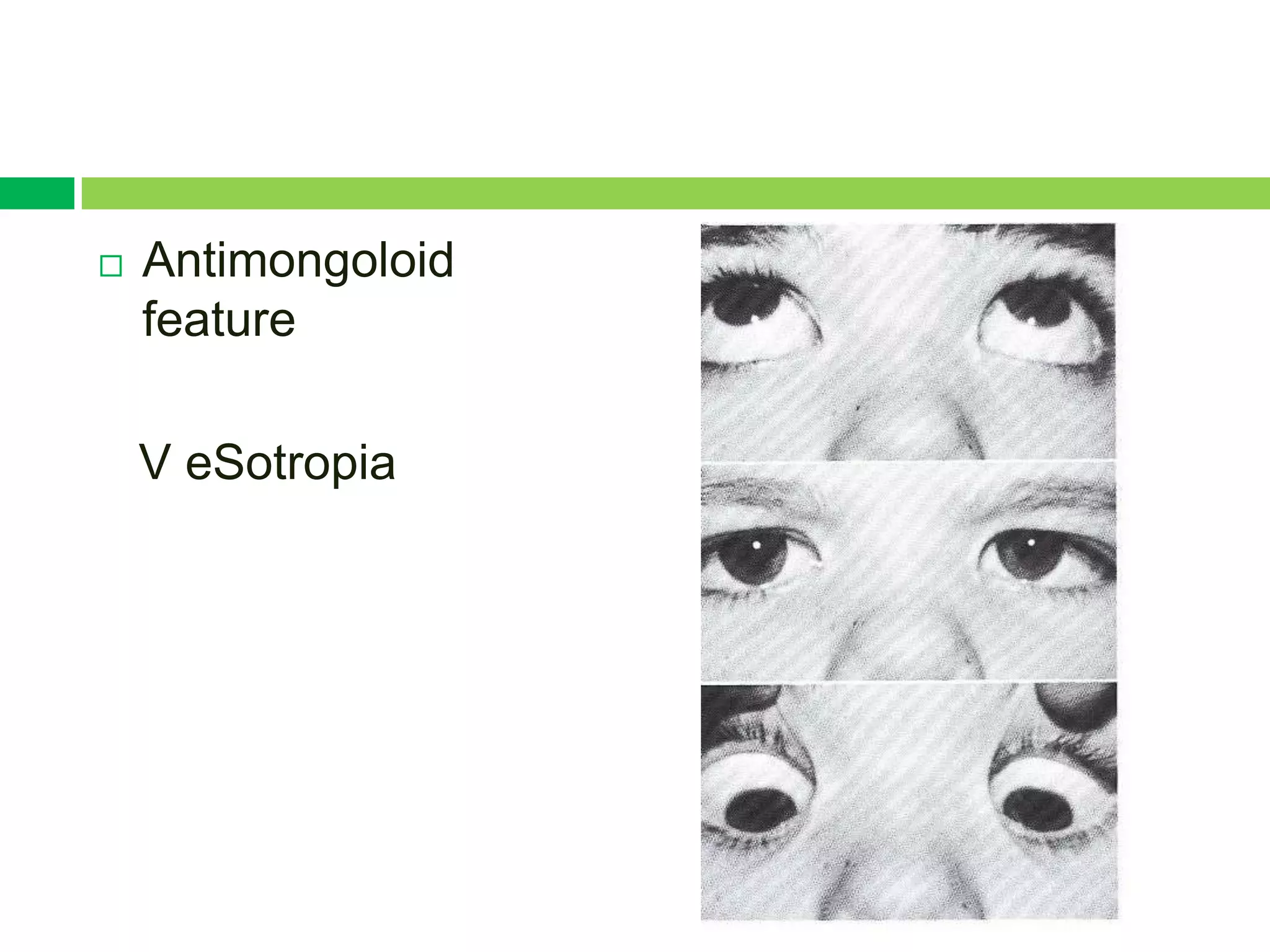    Antimongoloid
    feature

    V eSotropia
 