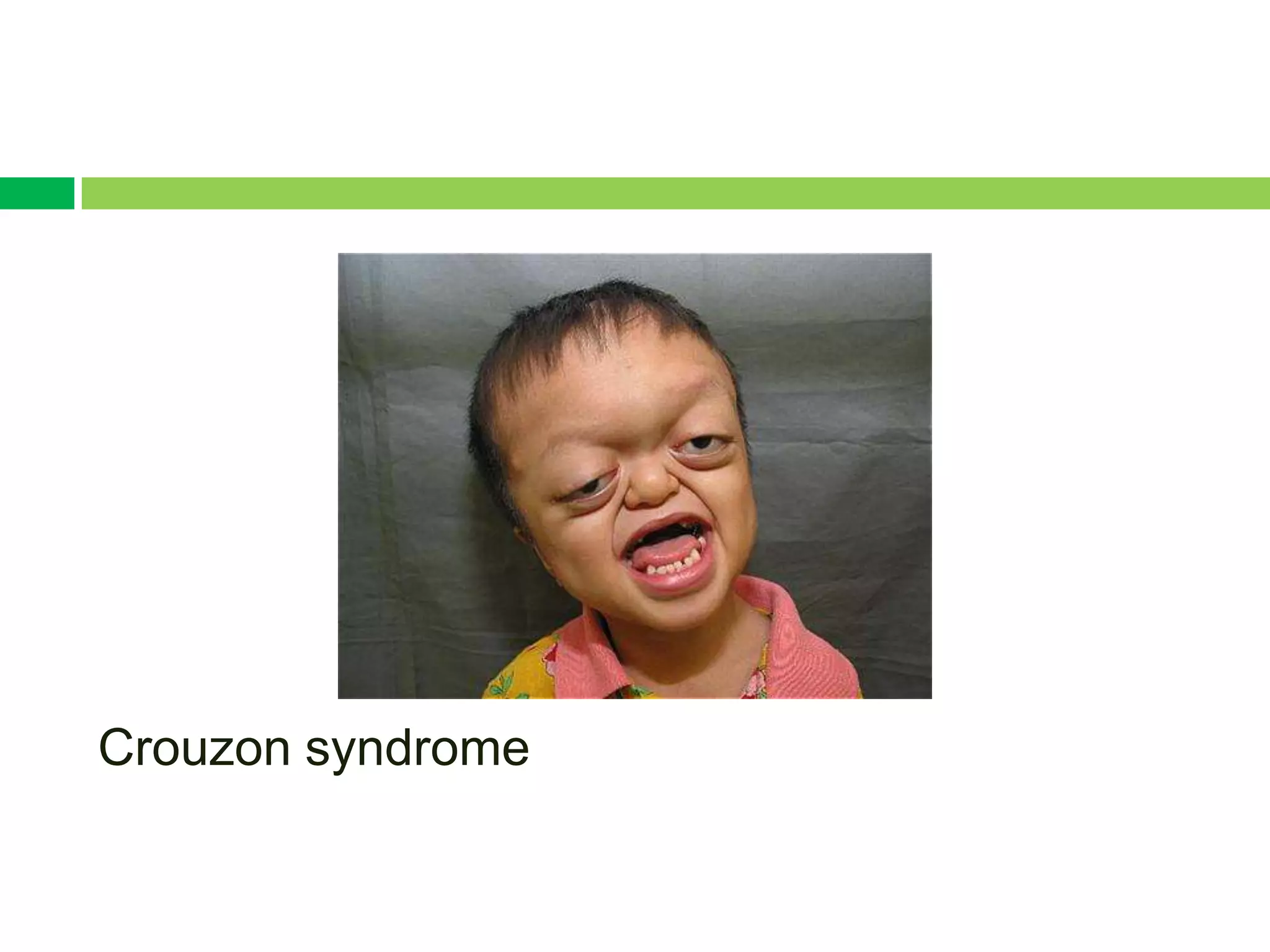 Crouzon syndrome
 
