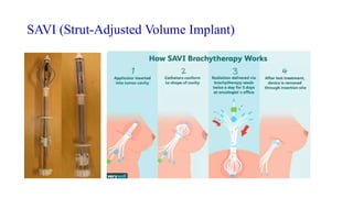 SAVI (Strut-Adjusted Volume Implant)
 