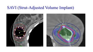 SAVI (Strut-Adjusted Volume Implant)
 