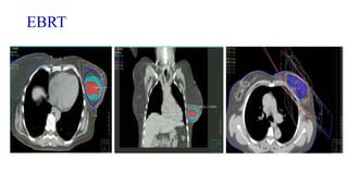 EBRT
 