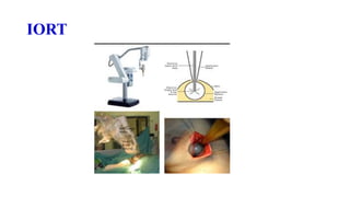 IORT
 