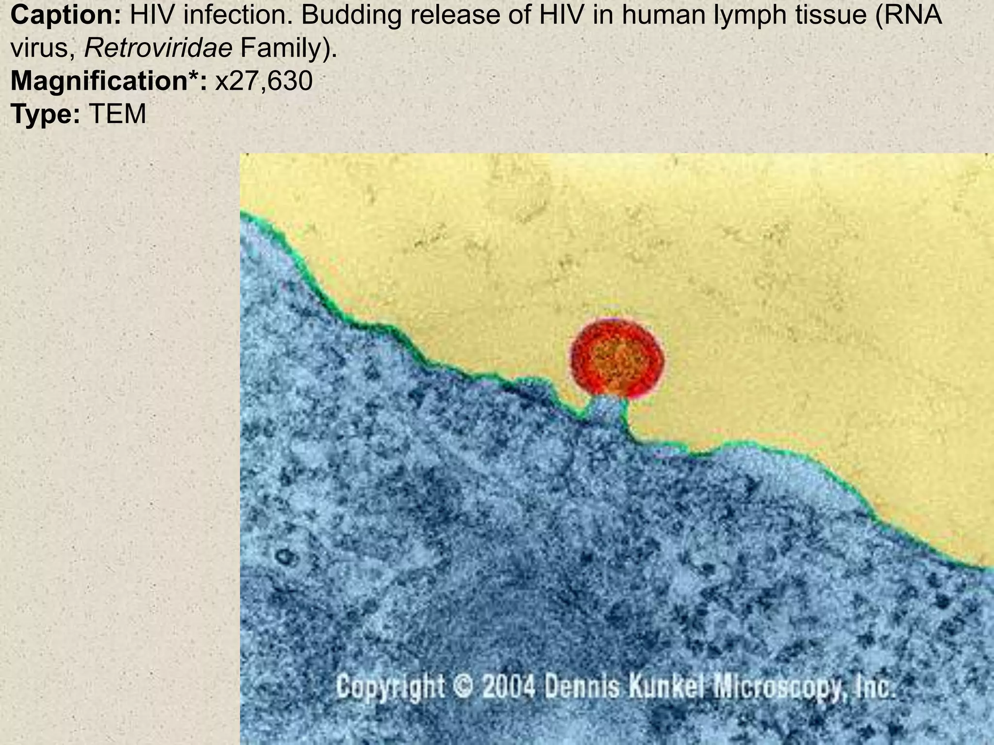 Caption: HIV infection. Budding release of HIV in human lymph tissue (RNA
virus, Retroviridae Family).
Magnification*: x27,630
Type: TEM
 