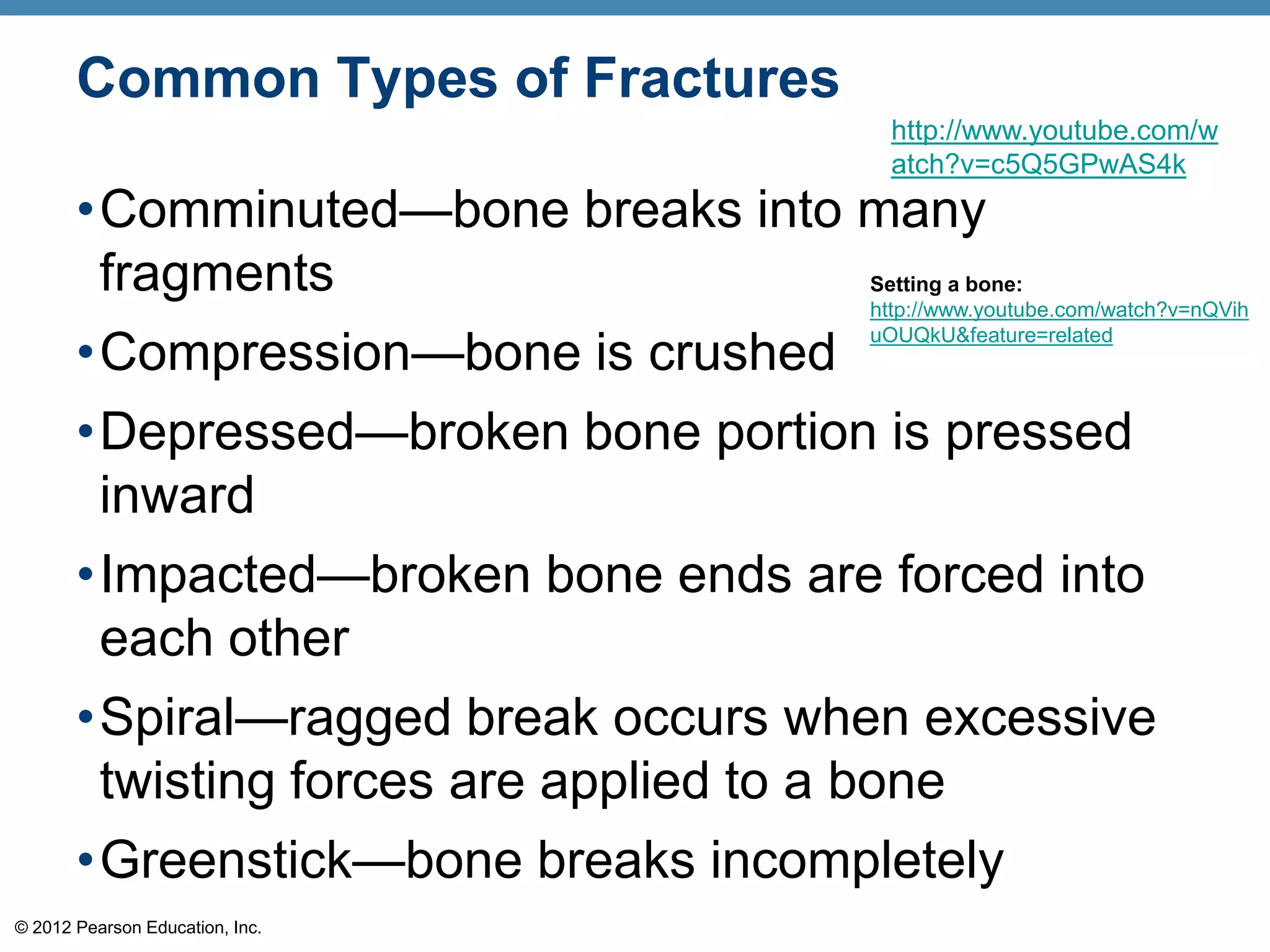 Common Types of Fractures
                                       http://www.youtube.com/w
                                       atch?v=c5Q5GPwAS4k
       •Comminuted—bone breaks into many
        fragments                    Setting a bone:
                                     http://www.youtube.com/watch?v=nQVih

       •Compression—bone is crushed
                                     uOUQkU&feature=related




       •Depressed—broken bone portion is pressed
        inward
       •Impacted—broken bone ends are forced into
        each other
       •Spiral—ragged break occurs when excessive
        twisting forces are applied to a bone
       •Greenstick—bone breaks incompletely
© 2012 Pearson Education, Inc.
 