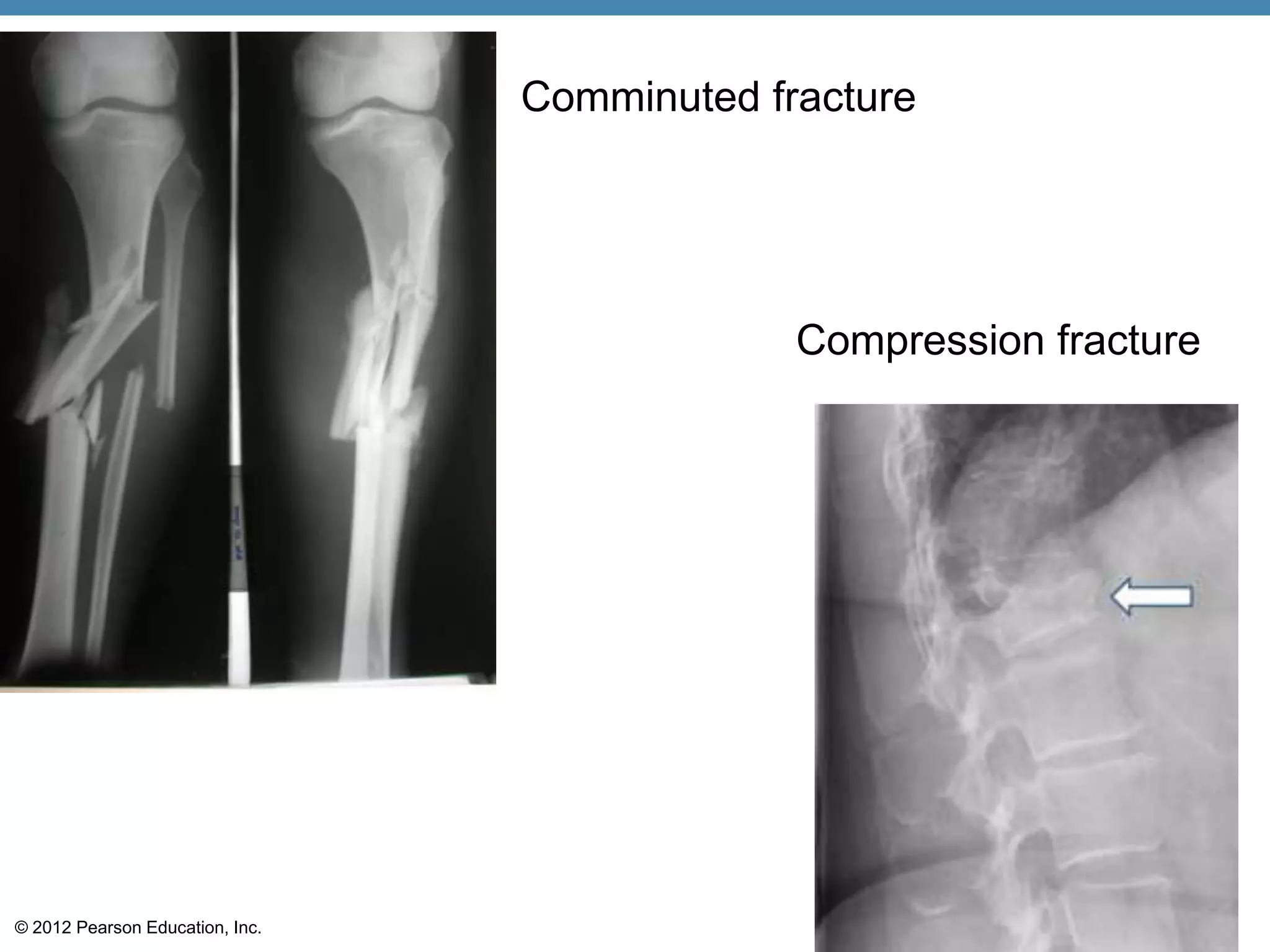 Comminuted fracture




                                              Compression fracture




© 2012 Pearson Education, Inc.
 