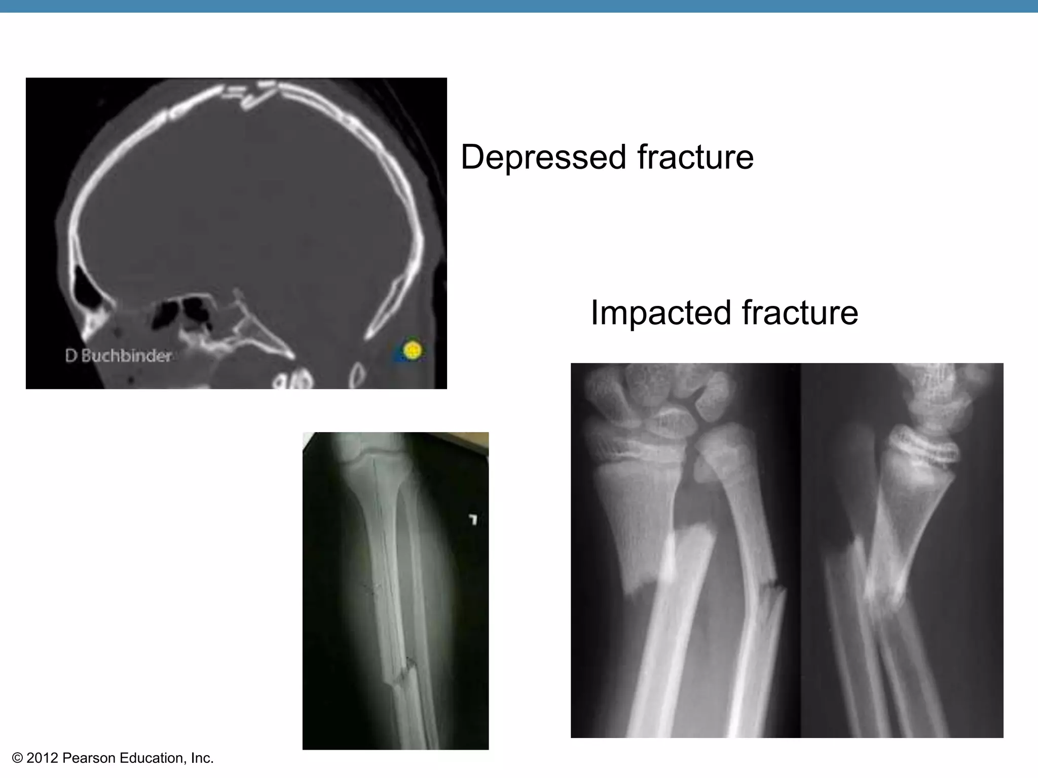 Depressed fracture



                                        Impacted fracture




© 2012 Pearson Education, Inc.
 