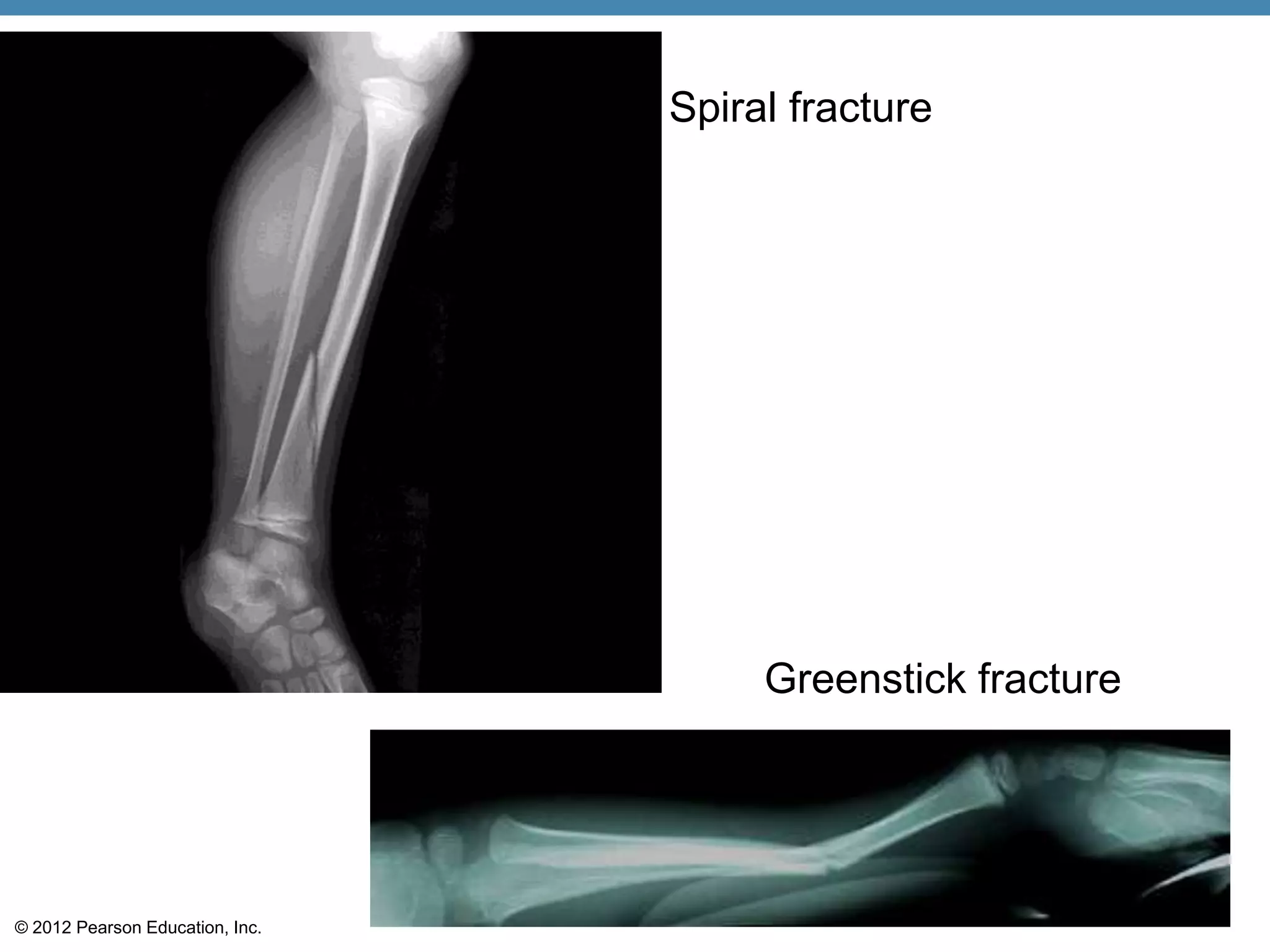 Spiral fracture




                                      Greenstick fracture




© 2012 Pearson Education, Inc.
 