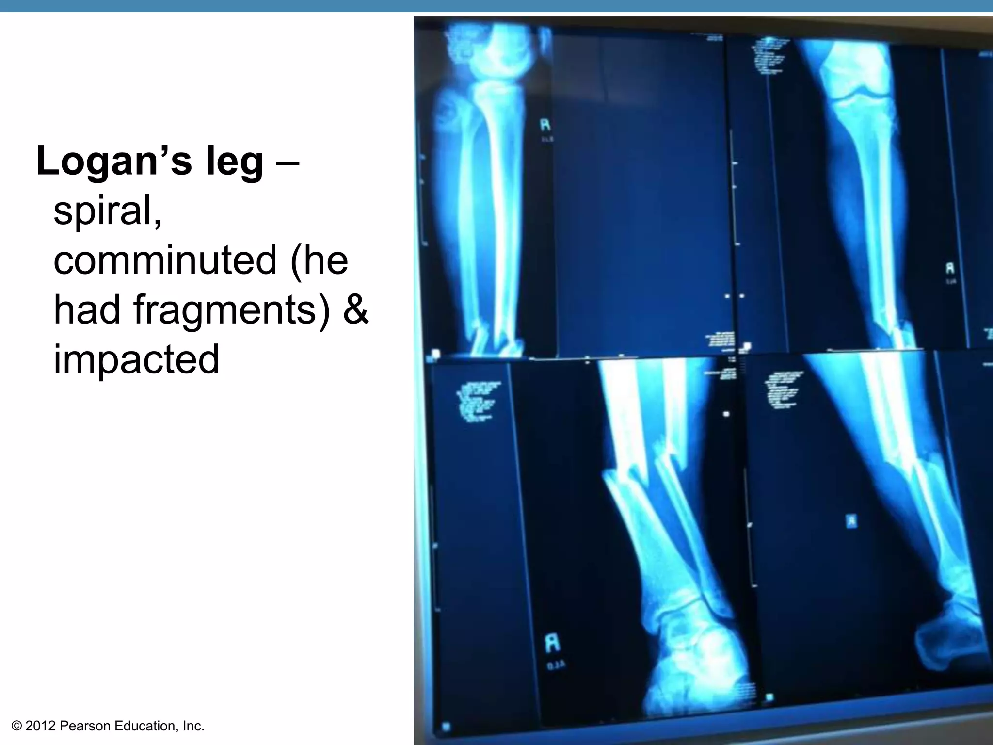 Logan’s leg –
    spiral,
    comminuted (he
    had fragments) &
    impacted




© 2012 Pearson Education, Inc.
 