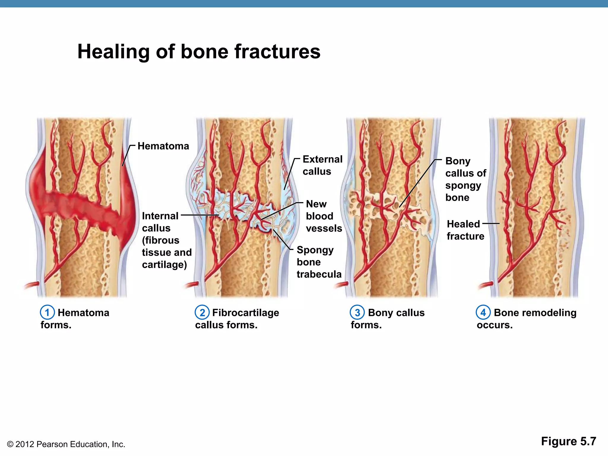 Healing of bone fractures



                                 Hematoma
                                                                   External                    Bony
                                                                   callus                      callus of
                                                                                               spongy
                                                                                               bone
                                                                   New
                                 Internal                          blood
                                 callus                            vessels                     Healed
                                 (fibrous                                                      fracture
                                 tissue and                       Spongy
                                 cartilage)                       bone
                                                                  trabecula


         1 Hematoma                            2 Fibrocartilage                3 Bony callus          4 Bone remodeling
        forms.                                callus forms.                   forms.                 occurs.




© 2012 Pearson Education, Inc.                                                                                  Figure 5.7
 