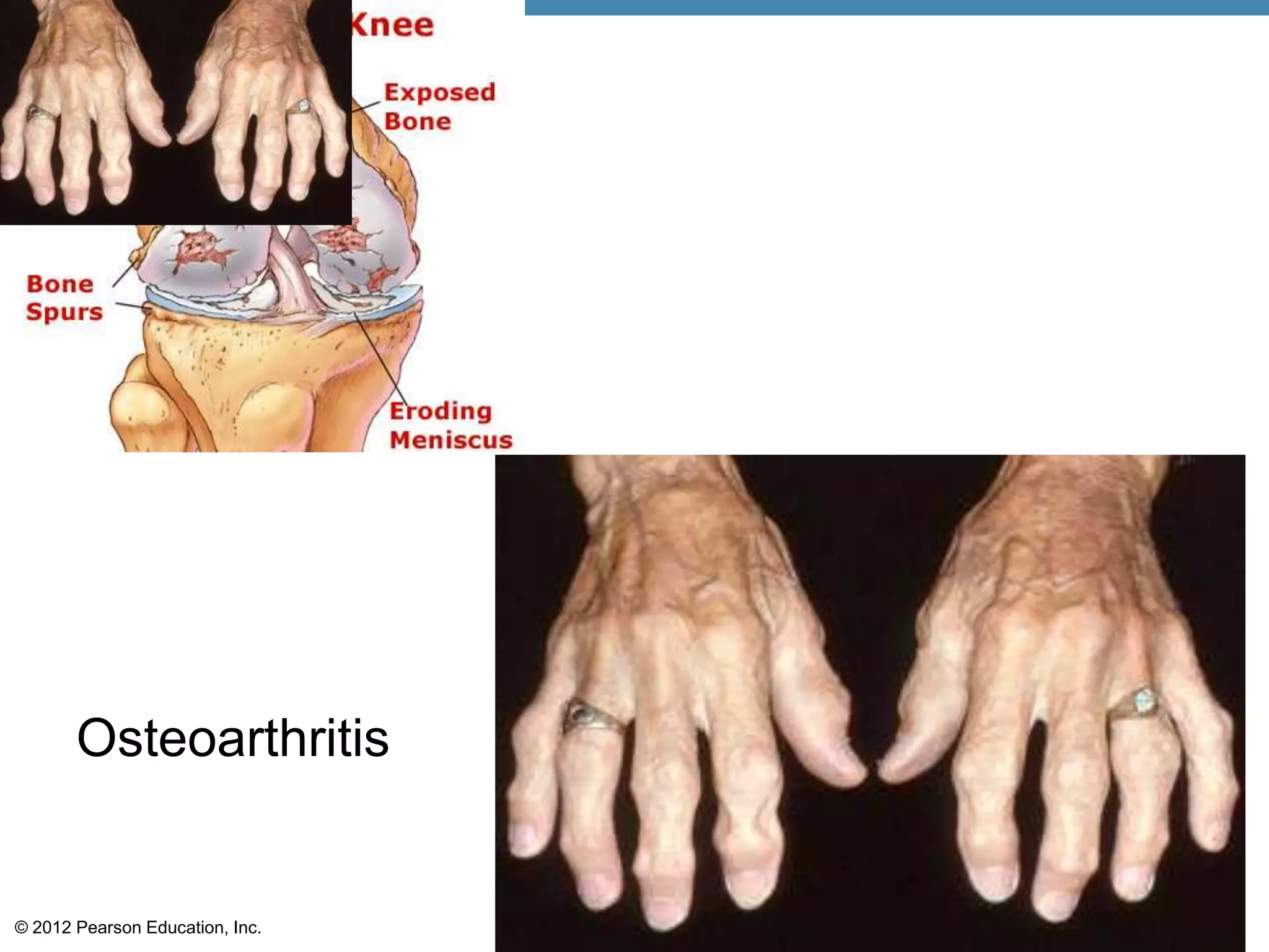 Osteoarthritis


© 2012 Pearson Education, Inc.
 