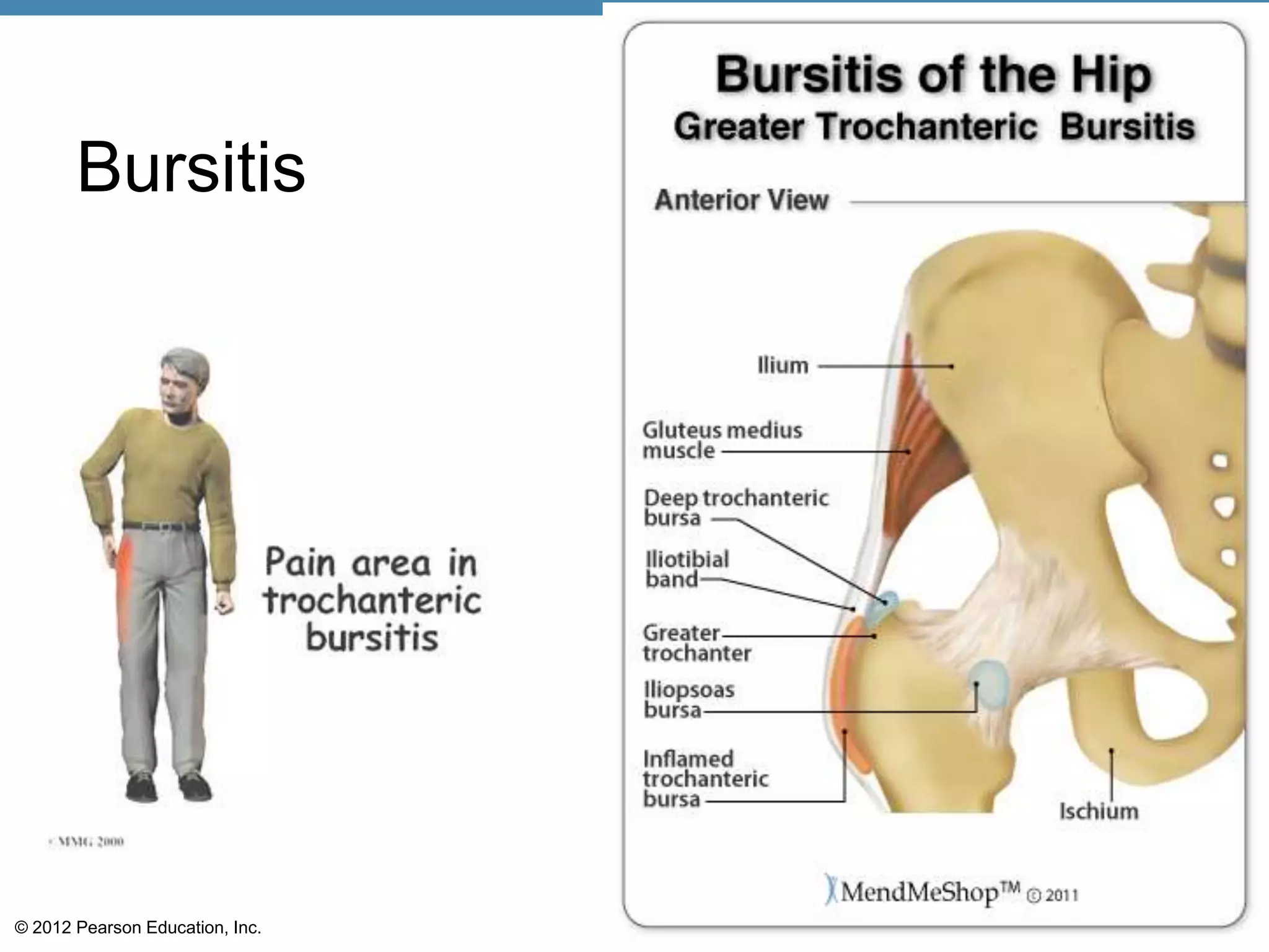 Bursitis




© 2012 Pearson Education, Inc.
 
