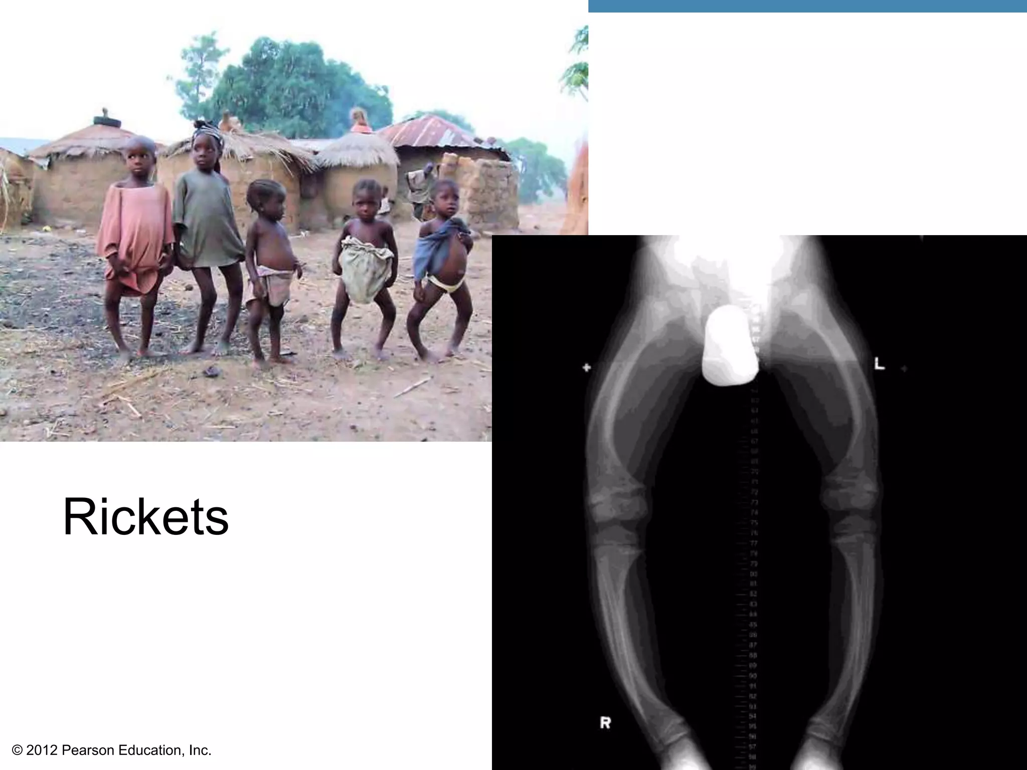 Rickets



© 2012 Pearson Education, Inc.
 