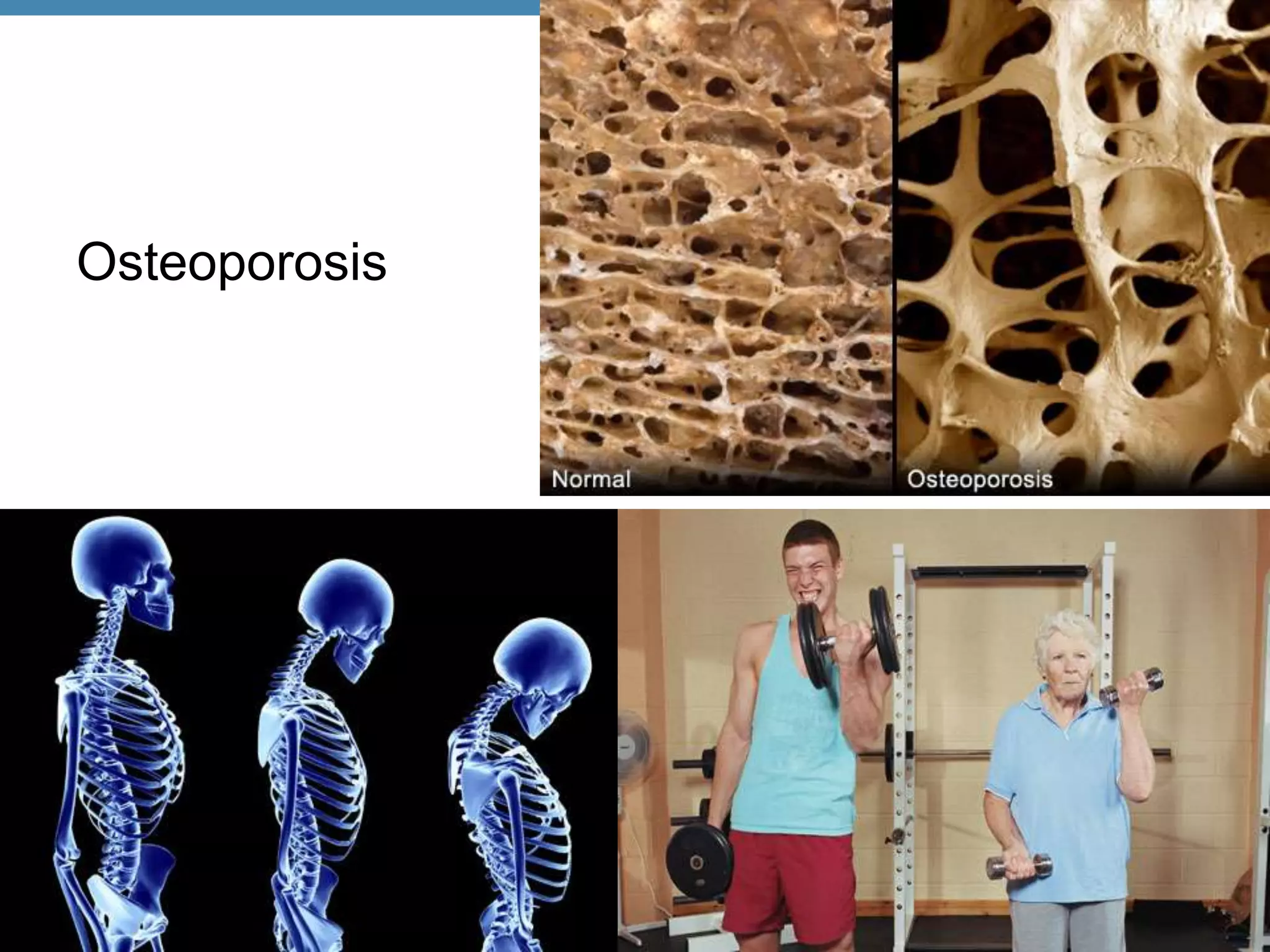 Osteoporosis




© 2012 Pearson Education, Inc.
 