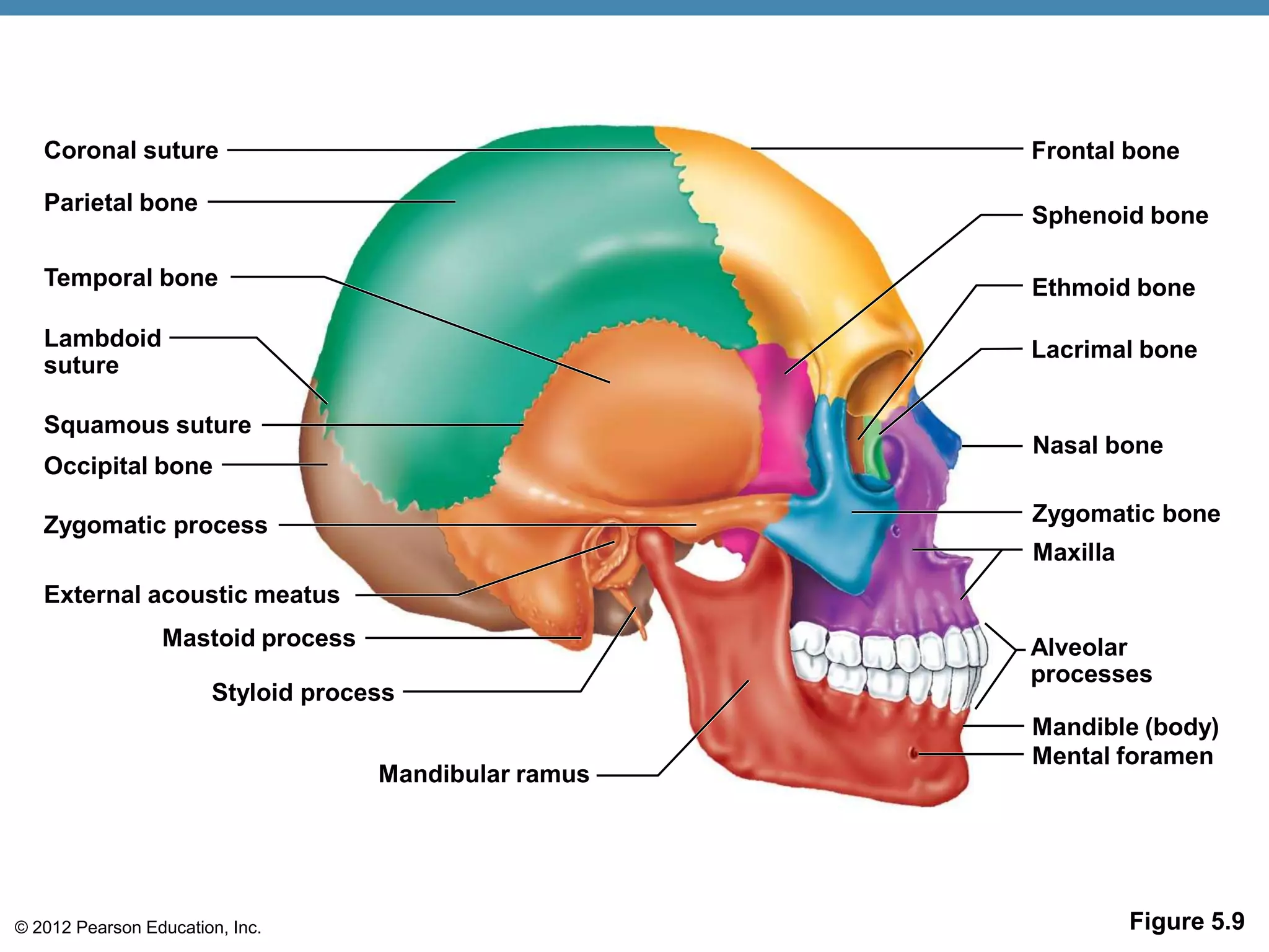 Coronal suture                                      Frontal bone

   Parietal bone
                                                       Sphenoid bone

   Temporal bone                                       Ethmoid bone

   Lambdoid                                            Lacrimal bone
   suture

   Squamous suture
                                                       Nasal bone
   Occipital bone

   Zygomatic process                                   Zygomatic bone
                                                       Maxilla
   External acoustic meatus
                 Mastoid process                       Alveolar
                                                       processes
                       Styloid process
                                                       Mandible (body)
                                                       Mental foramen
                                    Mandibular ramus




© 2012 Pearson Education, Inc.                                   Figure 5.9
 