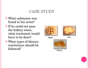 CASE STUDY What substance was found in his urine? If he could not pass the kidney stone, what treatment would have to be done? What types of dietary restrictions should be followed? 