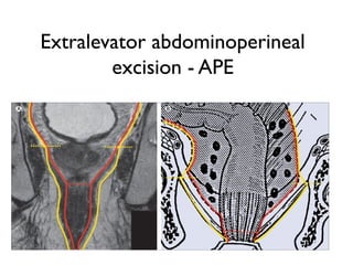 Extralevator abdominoperineal
excision - APE
 