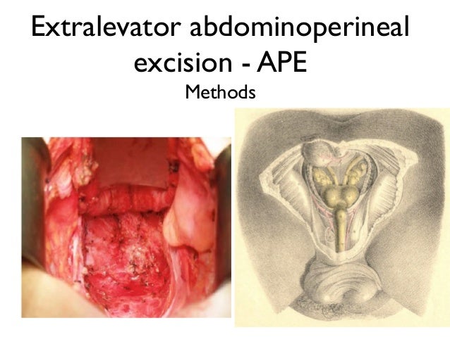 Extralevator abdominoperineal excision
