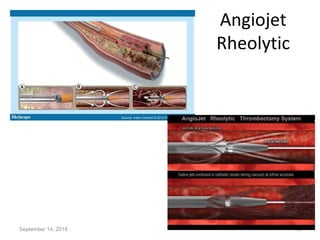 Acute pulmonary embolism - risk stratification and management | PPT