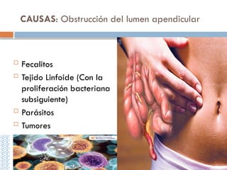 CAUSAS: Obstrucción del lumen apendicular
 Fecalitos
 Tejido Linfoide (Con la
proliferación bacteriana
subsiguiente)
 Parásitos
 Tumores
 