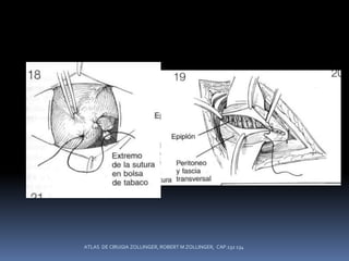 ATLAS DE CIRUGIA ZOLLINGER, ROBERT M ZOLLINGER, CAP.132 134
 