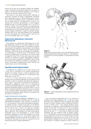 E – 40-505 ¶ Apendicectomía laparoscópica

menos de 10 mm en los pliegues radiales del ombligo.
Luego, utilizando una pinza de disección con garra, se
coge y se levanta la inserción umbilical, y en su base se
practica una incisión transversal de 8 mm.
Allí existe un solo plano aponeurótico adherido al
peritoneo. Después de haber comprobado, mediante
unos separadores, que no existen adherencias, se introduce un trocar atraumático (romo o retráctil) de 10 mm,
que se dirige hacia la cavidad pélvica. Gracias a lo
estrecho de la incisión aponeurótica, se evita cualquier
pérdida de gas. Se insufla alrededor de 1 l de CO2 a
razón de 1 l/min. Con el endoscopio, se comprueba que
el trocar está bien colocado, y que durante esta etapa de
la operación no se han causado lesiones. Así pues, no se
ejecuta ninguna maniobra a ciegas. La presión intraabdominal debe ser lo más baja posible, pero compatible
con las necesidades de la intervención. Salvo en los
casos de obesidad, basta con 7 mmHg.

1
2

3

A

Exploración abdominal y colocación
del trocar T2
Para practicar la exploración endoscópica de la cavidad abdominal, puede ser necesario modificar la posición de la mesa de operaciones. Se examina el aspecto
macroscópico del apéndice, del peritoneo, del intestino
delgado terminal, del marco cólico, del aparato genital
femenino y del fondo de saco de Douglas. Si el apéndice
es normotópico, resultará fácil de identificar. Para
mejorar la exploración, se introduce con control visual
un segundo trocar T2 de 5 mm, para lo que, por razones
estéticas, se prefiere la región suprapúbica izquierda.
Esta vía sirve para introducir un palpador, útil a la hora
de encontrar los apéndices ectópicos o patológicos. Si
existe un derrame intraperitoneal, debe tomarse una
muestra para examen bacteriológico.

1
3

2

B
Figura 4.
A, B. Posición de los trocares y de la instrumentación para la
apendicectomía laterocecal interna o pélvica. 1. Trocar óptico; 2.
instrumental en la mano izquierda; 3. instrumental en la mano
derecha.

Apendicectomía laparoscópica
El dispositivo se completa con un tercer trocar T3 de
5 mm, que se introduce en la región subumbilical
derecha. El cirujano expone y toma el apéndice manejando con su mano izquierda los instrumentos que
pasan por el trocar T2.
El T3 es el trocar operatorio cercano a la mano
derecha, pero su posición depende de la localización del
apéndice. Como en cualquier procedimiento laparoscópico, deben respetarse los principios ergonómicos,
evaluando la angulación entre T2 y T3 y evitando la
excesiva proximidad respecto al campo quirúrgico. Una
posición demasiado lateral en las fosas ilíacas o en los
flancos resultaría perjudicial. Siempre hay que conservar
el eje cirujano-campo quirúrgico-monitor. El estado
patológico del apéndice puede justificar la instalación de
un trocar de 10 mm en T3.

Figura 5. Tracción del apéndice y electrocoagulación del meso
con pinza bipolar.

Según la localización del apéndice
Apéndice laterocecal interno o pélvico (Fig. 4).
Introduciendo una pinza fenestrada por T2, se coge la
extremidad del apéndice y éste se pone en tensión. En
T3, con una pinza o unas tijeras hemostáticas bipolares,
se coagula el meso, y luego se secciona, ya sea directamente, a nivel de su base, permaneciendo a no menos
de 10 mm de ésta, o bien a lo largo del apéndice
(Fig. 5). Una vez expuesta la base apendicular, se puede
ligar el apéndice, bien mediante un nudo intracorporal,
utilizando uno o dos portaagujas, o, lo que resulta
preferible, mediante un nudo extracorporal, con ayuda
de un empujanudos (Fig. 6). Se aconseja realizar una
segunda ligadura 10 mm por encima de la anterior, con
el objetivo principal de evitar la evacuación de un
estercolito hacia la cavidad abdominal [4].

4

Con unas tijeras introducidas por T3, se secciona el
apéndice entre ambas ligaduras (Fig. 7). Hay que evitar
la sección por coagulación mono o bipolar, que podría
destruir la sutura. Cuando existen fenómenos infecciosos en el fondo cecal, y una simple ligadura parece
insuficiente o peligrosa, resulta preferible resecar dicho
fondo. En este caso, el trocar T3 de 5 mm se sustituye
por otro de 12 mm, y se introduce un aparato de sutura
lineal de 30 mm [18, 19]. Para evitar el riesgo de oclusión
intestinal, hay que eliminar todas las grapas residuales [20]. El apéndice se coloca en una bolsa de extracción
introducida por el trocar T1. El control visual se realiza
desplazando la óptica hacia un trocar de 10 mm, que
puede haberse instalado en T3. De lo contrario, la vaina
del extractor se suprime después de haber soltado la
Técnicas quirúrgicas Digestivo

 