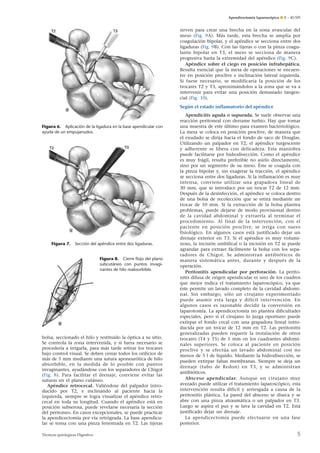 Apendicectomía laparoscópica ¶ E – 40-505

sirven para crear una brecha en la zona avascular del
meso (Fig. 9A). Más tarde, esta brecha se amplía por
coagulación bipolar, y el apéndice se secciona entre dos
ligaduras (Fig. 9B). Con las tijeras o con la pinza coagulante bipolar en T3, el meso se secciona de manera
progresiva hasta la extremidad del apéndice (Fig. 9C).
Apéndice sobre el ciego en posición infrahepática.
Resulta esencial que la mesa de operaciones se encuentre en posición proclive e inclinación lateral izquierda.
Si fuese necesario, se modificaría la posición de los
trocares T2 y T3, aproximándolos a la zona que se va a
intervenir para evitar una posición demasiado tangencial (Fig. 10).
Según el estado inflamatorio del apéndice

Figura 6. Aplicación de la ligadura en la base apendicular con
ayuda de un empujanudos.

Figura 7.

Sección del apéndice entre dos ligaduras.

Figura 8. Cierre ﬂojo del plano
subcutáneo con puntos invaginantes de hilo reabsorbible.

bolsa, seccionado el hilo y restituido la óptica a su sitio.
Se controla la zona intervenida, y si fuera necesario se
procedería a irrigarla, para más tarde retirar los trocares
bajo control visual. Se deben cerrar todos los orificios de
más de 5 mm mediante una sutura aponeurótica de hilo
absorbible, en la medida de lo posible con puntos
invaginantes, ayudándose con los separadores de Chigot
(Fig. 8). Para facilitar el drenaje, conviene evitar las
suturas en el plano cutáneo.
Apéndice retrocecal. Valiéndose del palpador introducido por T2, e inclinando al paciente hacia la
izquierda, siempre se logra visualizar el apéndice retrocecal en toda su longitud. Cuando el apéndice está en
posición subserosa, puede revelarse necesaria la sección
del peritoneo. En casos excepcionales, se puede practicar
la apendicectomía por vía retrógrada. La base apendicular se tensa con una pinza fenestrada en T2. Las tijeras
Técnicas quirúrgicas Digestivo

Apendicitis aguda o supurada. Se suele observar una
reacción peritoneal con derrame turbio. Hay que tomar
una muestra de este último para examen bacteriológico.
La mesa se coloca en posición proclive, de manera que
el exudado se dirija hacia el fondo de saco de Douglas.
Utilizando un palpador en T2, el apéndice turgescente
y adherente se libera con delicadeza. Esta maniobra
puede facilitarse por hidrodisección. Como el apéndice
es muy frágil, resulta preferible no asirlo directamente,
sino por un segmento de su meso. Éste se coagula con
la pinza bipolar y, sin exagerar la tracción, el apéndice
se secciona entre dos ligaduras. Si la inflamación es muy
intensa, conviene utilizar una grapadora lineal de
30 mm, que se introduce por un trocar T2 de 12 mm.
Después de la desinfección, el apéndice se coloca dentro
de una bolsa de recolección que se retira mediante un
trocar de 10 mm. Si la extracción de la bolsa plantea
problemas, puede dejarse de modo provisional dentro
de la cavidad abdominal y extraerla al terminar el
procedimiento. Al final de la intervención, con el
paciente en posición proclive, se irriga con suero
fisiológico. En algunos casos está justificado dejar un
drenaje exterior en T3. Si el apéndice es muy voluminoso, la incisión umbilical o la incisión en T2 se puede
agrandar para extraer fácilmente la bolsa con los separadores de Chigot. Se administran antibióticos de
manera sistemática antes, durante y después de la
operación.
Peritonitis apendicular por perforación. La peritonitis difusa de origen apendicular es uno de los cuadros
que mejor indica el tratamiento laparoscópico, ya que
éste permite un lavado completo de la cavidad abdominal. Sin embargo, sólo un cirujano experimentado
puede asumir esta larga y difícil intervención. En
algunos casos es razonable decidir la conversión en
laparotomía. La apendicectomía no plantea dificultades
especiales, pero si el cirujano lo juzga oportuno puede
extirpar el fondo cecal con una grapadora lineal introducida por un trocar de 12 mm en T2. Las peritonitis
generalizadas pueden requerir la instalación de otros
trocares (T4 y T5) de 5 mm en los cuadrantes abdominales superiores. Se coloca al paciente en posición
proclive y se efectúa un lavado abdominal con no
menos de 5 l de líquido. Mediante la hidrodisección, se
pueden extirpar falsas membranas. Siempre se deja un
drenaje (tubo de Redon) en T3, y se administran
antibióticos.
Absceso apendicular. Aunque un cirujano muy
avezado puede utilizar el tratamiento laparoscópico, esta
intervención resulta difícil y arriesgada a causa de la
peritonitis plástica. La pared del absceso se diseca y se
abre con una pinza atraumática o un palpador en T3.
Luego se aspira el pus y se lava la cavidad en T2. Está
justificado dejar un drenaje.
La apendicectomía puede efectuarse en una fase
posterior.

5

 