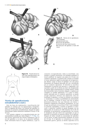 E – 40-505 ¶ Apendicectomía laparoscópica

Figura 9. Técnica de la apendicectomía retrógrada.
A. Abertura del meso.
B. Sección del apéndice.
C. Sección del meso hasta la punta.
D. Extracción del apéndice a través del
trocar.

Figura 10. Posición de los trocares para apendicectomía con
ciego ectópico infrahepático.

Técnica de apendicectomía
extraabdominal («out»)
Sólo las fases de exploración y movilización del
apéndice se realizan por vía laparoscópica intraperitoneal. La ligadura del meso y la exéresis del apéndice se
practican en posición extraabdominal, después de haber
exteriorizado ambos elementos mediante el trocar T3 de
10 mm.
Una variante original es la apendicectomía por vía
transumbilical asistida por vídeo (Begin) [21, 22] (Fig. 11).
Esta técnica aprovecha dos hechos anatómicos: que el
eje del apéndice y su meso, en la posición habitual,
están orientados hacia la región umbilical, y que el

6

conjunto cecoapendicular, dada su movilidad, casi
siempre se puede exteriorizar con facilidad mediante el
trocar umbilical. Se requiere una óptica de 10 mm con
conducto operatorio. La primera fase consiste en instalar
el trocar operatorio según los principios de la laparoscopia abierta. Luego se busca el apéndice con una pinza
atraumática de longitud adecuada (40 cm), introducida
por el conducto operatorio. El intestino se moviliza
cambiando la posición del paciente y cogiéndolo con
suavidad a partir de la última asa ileal. Así, desplazando
el sistema óptico-instrumental en sentido lateral, resulta
fácil desenrollar todo el intestino delgado y explorar por
completo la cavidad abdominal. Si se pasa el instrumento adecuado por el conducto operatorio, se puede
recoger material y efectuar una aspiración. Una vez
localizado el apéndice, se toma su extremo con la pinza
y, tensándolo, se evalúa la posibilidad de exteriorizarlo
por el ombligo. Cuando el meso está fijo al plano
peritoneal posterior, hay que liberarlo con tijeras o
mediante coagulación monopolar, ayudándose, en caso
de que sea necesario, de un trocar T2 de 5 mm instalado
en posición suprapúbica. Cuando el apéndice es retrocecal o subseroso, también se puede despegar con las
tijeras parte de la fascia de Toldt derecha con el fin de
posibilitar la movilización cecoapendicular. Las vísceras
se desplazan sólo por efecto de la gravedad, ya que el
paciente se encuentra en posición lateral. Por lo general,
después de haber tomado la extremidad del apéndice
con la pinza, se logra exteriorizarlo mediante un trocar
de 10 mm. Si el apéndice es voluminoso o el meso
demasiado grueso, gracias al diseño específico de la
Técnicas quirúrgicas Digestivo

 