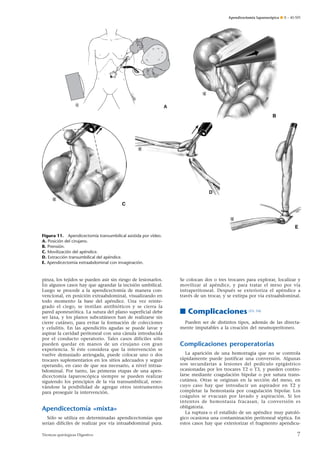 Apendicectomía laparoscópica ¶ E – 40-505

A

Figura 11. Apendicectomía transumbilical asistida por vídeo.
A. Posición del cirujano.
B. Prensión.
C. Movilización del apéndice.
D. Extracción transumbilical del apéndice.
E. Apendicectomía extraabdominal con invaginación.

pinza, los tejidos se pueden asir sin riesgo de lesionarlos.
En algunos casos hay que agrandar la incisión umbilical.
Luego se procede a la apendicectomía de manera convencional, en posición extraabdominal, visualizando en
todo momento la base del apéndice. Una vez reintegrado el ciego, se instilan antibióticos y se cierra la
pared aponeurótica. La sutura del plano superficial debe
ser laxa, y los planos subcutáneos han de realizarse sin
cierre cutáneo, para evitar la formación de colecciones
y celulitis. En las apendicitis agudas se puede lavar y
aspirar la cavidad peritoneal con una cánula introducida
por el conducto operatorio. Tales casos difíciles sólo
pueden quedar en manos de un cirujano con gran
experiencia. Si éste considera que la intervención se
vuelve demasiado arriesgada, puede colocar uno o dos
trocares suplementarios en los sitios adecuados y seguir
operando, en caso de que sea necesario, a nivel intraabdominal. Por tanto, las primeras etapas de una apendicectomía laparoscópica siempre se pueden realizar
siguiendo los principios de la vía transumbilical, reservándose la posibilidad de agregar otros instrumentos
para proseguir la intervención.

Apendicectomía «mixta»
Sólo se utiliza en determinadas apendicectomías que
serían difíciles de realizar por vía intraabdominal pura.
Técnicas quirúrgicas Digestivo

Se colocan dos o tres trocares para explorar, localizar y
movilizar al apéndice, y para tratar el meso por vía
intraperitoneal. Después se exterioriza el apéndice a
través de un trocar, y se extirpa por vía extraabdominal.

■ Complicaciones

[23, 24]

Pueden ser de distintos tipos, además de las directamente imputables a la creación del neumoperitoneo.

Complicaciones peroperatorias
La aparición de una hemorragia que no se controla
rápidamente puede justificar una conversión. Algunas
son secundarias a lesiones del pedículo epigástrico
ocasionadas por los trocares T2 o T3, y pueden controlarse mediante coagulación bipolar o por sutura transcutánea. Otras se originan en la sección del meso, en
cuyo caso hay que introducir un aspirador en T2 y
completar la hemostasia por coagulación bipolar. Los
coágulos se evacuan por lavado y aspiración. Si los
intentos de hemostasia fracasan, la conversión es
obligatoria.
La ruptura o el estallido de un apéndice muy patológico ocasiona una contaminación peritoneal séptica. En
estos casos hay que exteriorizar el fragmento apendicu-

7

 