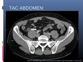 TAC ABDOMEN:

Arce JD. Apendicitis aguda: Perspectiva desde las imágenes. Rev Act Med 2007; 1: 20-30. Chile.

 