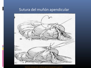 Sutura del muñón apendicular

http://www.medicosecuador.com/librosecng/articuloss/3/apendicitis_aguda.htm

 