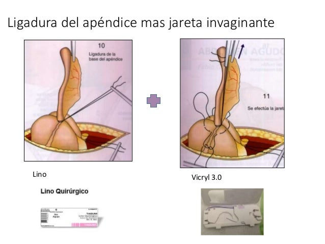 tecnica apendicectomia