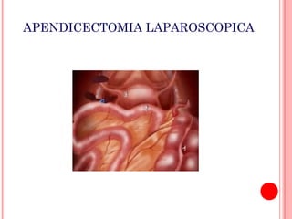 APENDICECTOMIA LAPAROSCOPICA

 