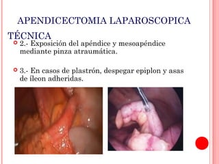 APENDICECTOMIA LAPAROSCOPICA
TÉCNICA


2.- Exposición del apéndice y mesoapéndice
mediante pinza atraumática.



3.- En casos de plastrón, despegar epiplon y asas
de íleon adheridas.

 