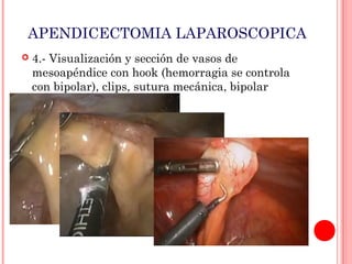 APENDICECTOMIA LAPAROSCOPICA


4.- Visualización y sección de vasos de
mesoapéndice con hook (hemorragia se controla
con bipolar), clips, sutura mecánica, bipolar

 