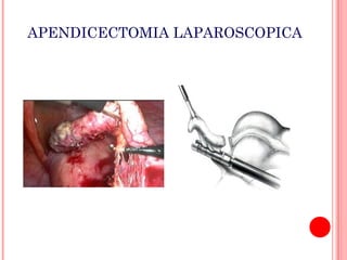 APENDICECTOMIA LAPAROSCOPICA

 