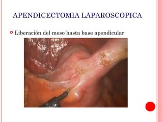 APENDICECTOMIA LAPAROSCOPICA


Liberación del meso hasta base apendicular

 